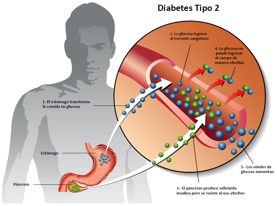 diabetes mellitus és merevedés