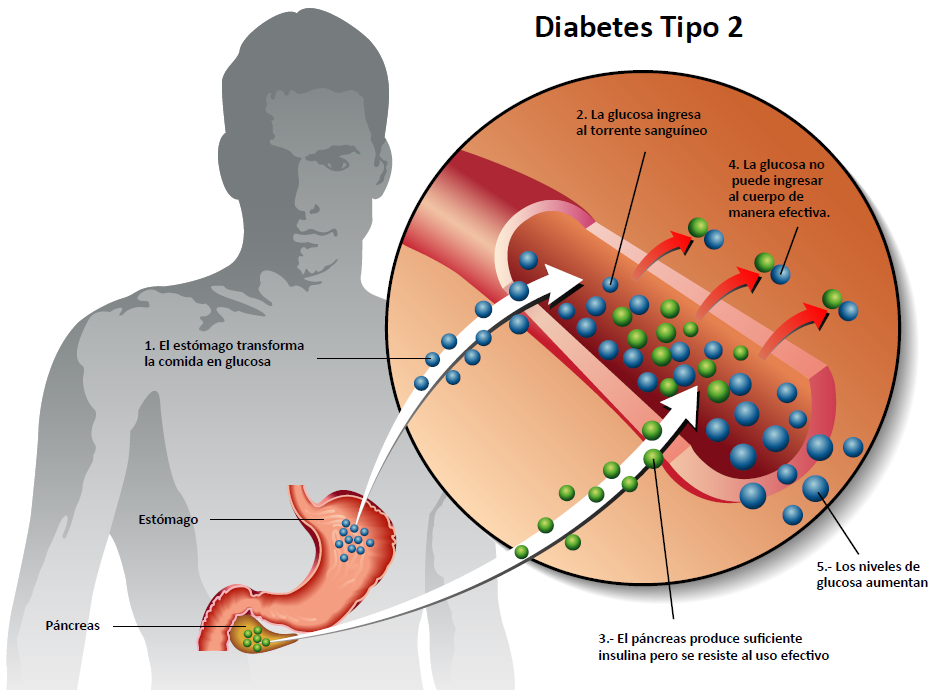 Diabetes mellitus esetén nincs erekció