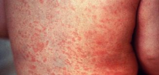 measles