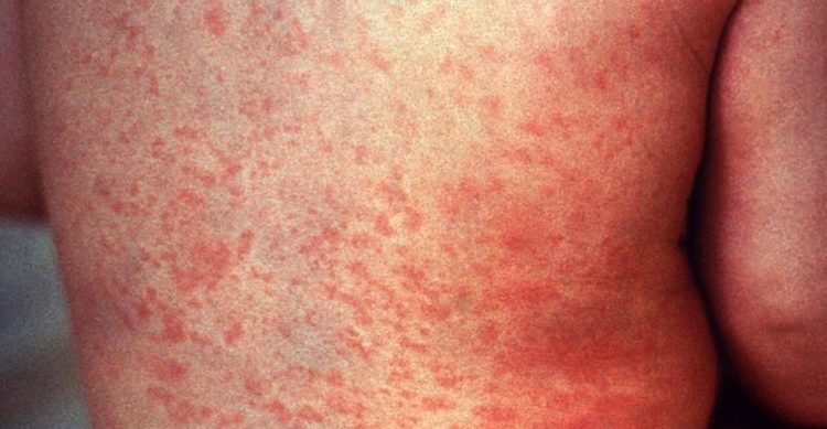 measles
