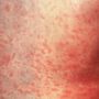 measles