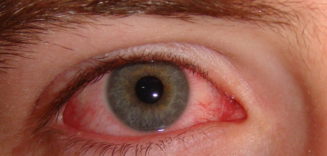 Pink Eye