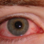 Pink Eye