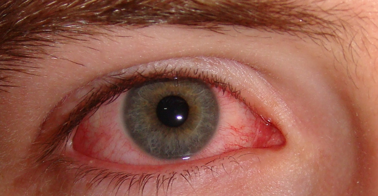 Pink Eye